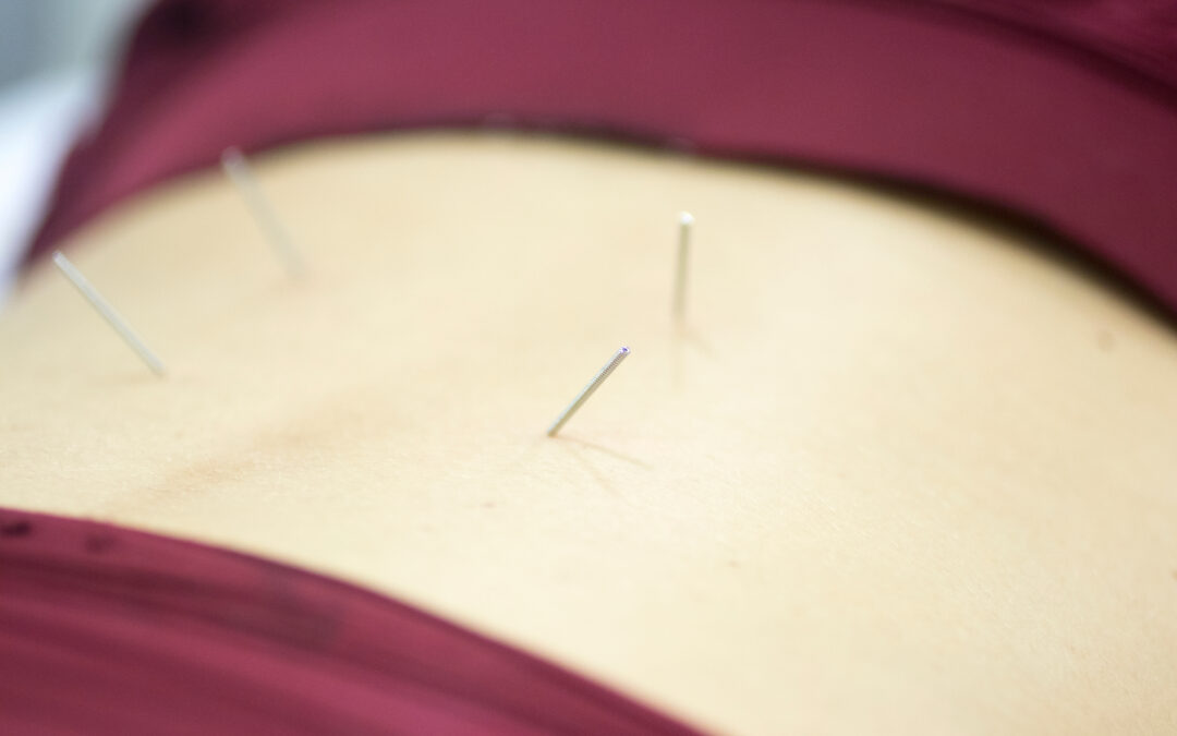 5 alternatives to dry needling that may have similar effects during physical therapy