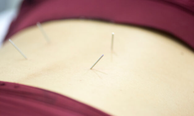 5 alternatives to dry needling that may have similar effects during physical therapy